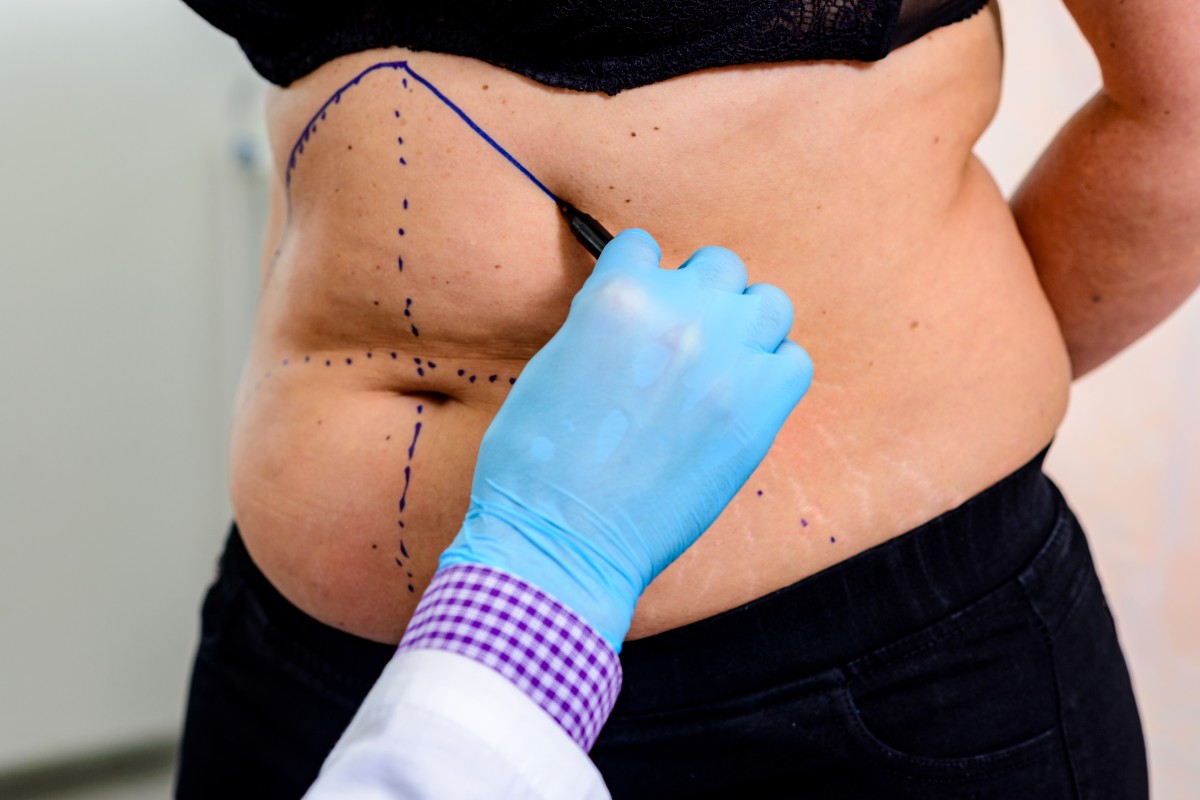 Lipomodelling (Lipofilling / Autologous Fat Grafting)