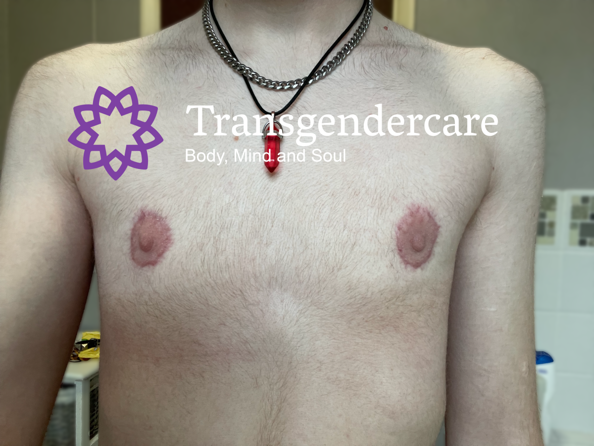 Peri Areolar Top Surgery 6 months with Mr Vahidi Transgendercare