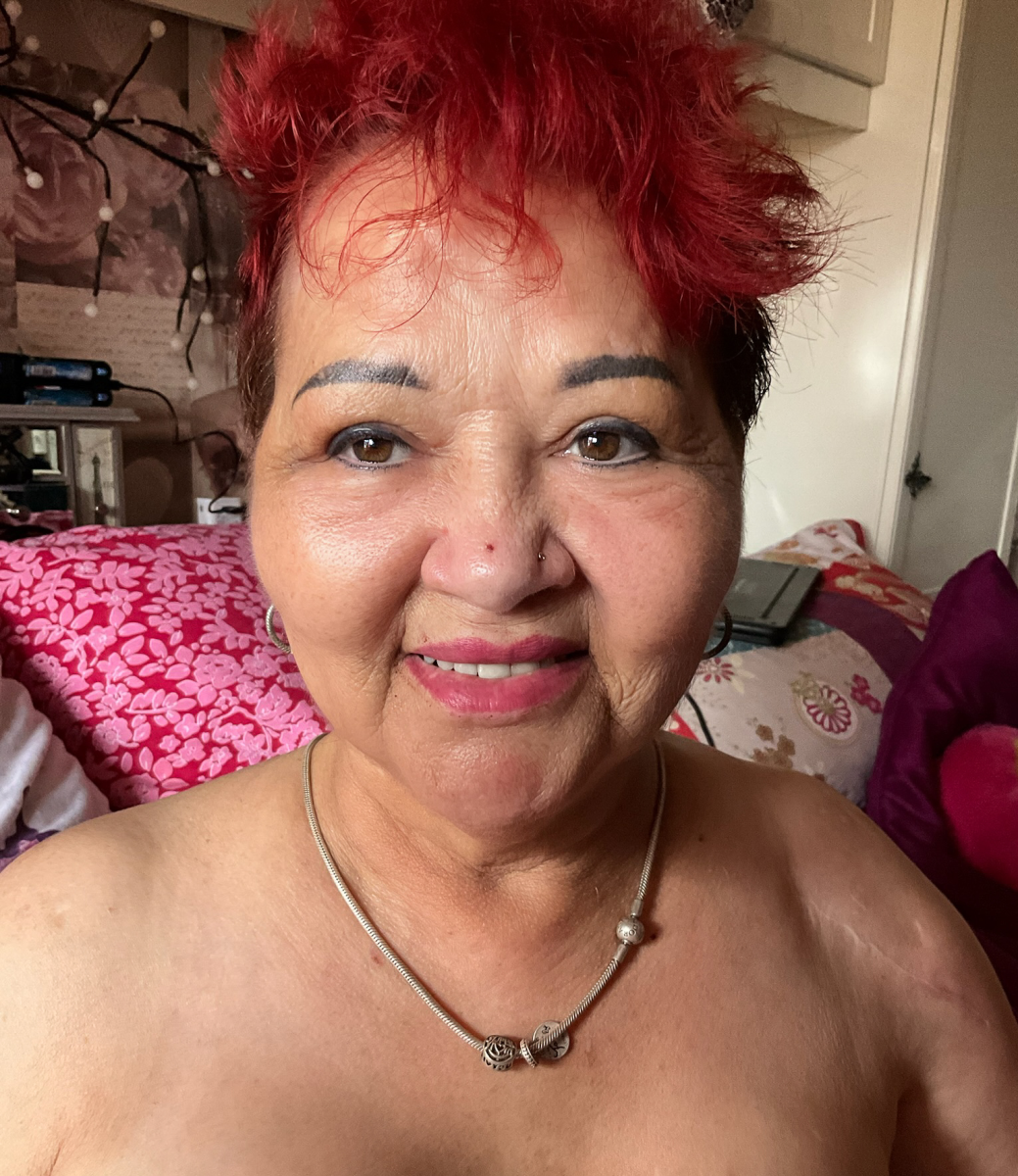 Blephroplasty by Mr Ardeshir Vahidi after surgery