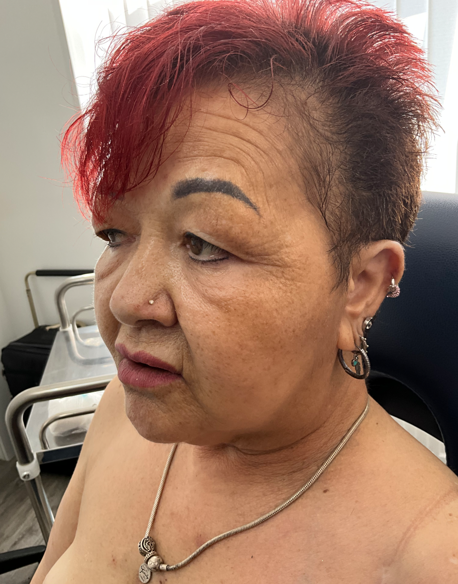 Blephroplasty by Mr Ardeshir Vahidi before surgery