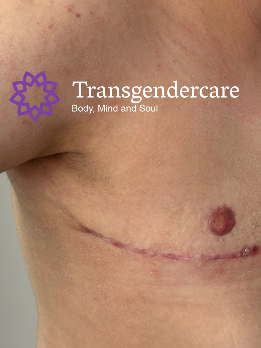 Top Surgery Mrs Ardeshir Vahid Transgendercare 5 weeks