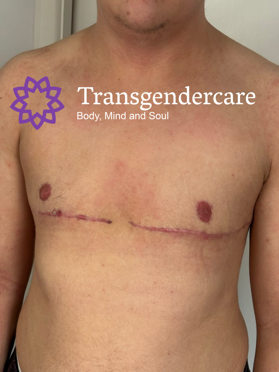 Top Surgery Mrs Ardeshir Vahid Transgendercare 5 weeks