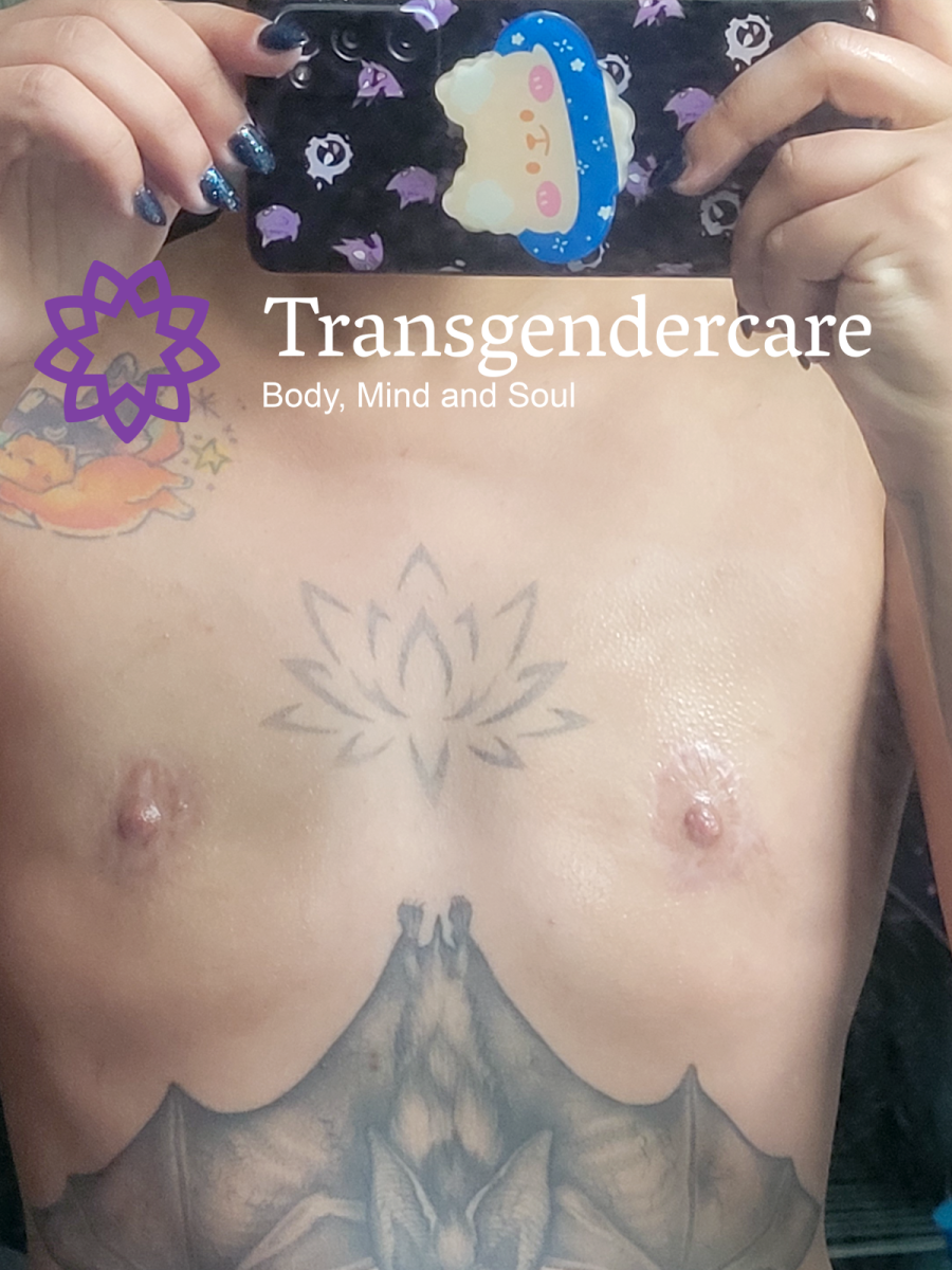Peri Areolar Top Surgery 6 months with Mr Vahidi Transgendercare