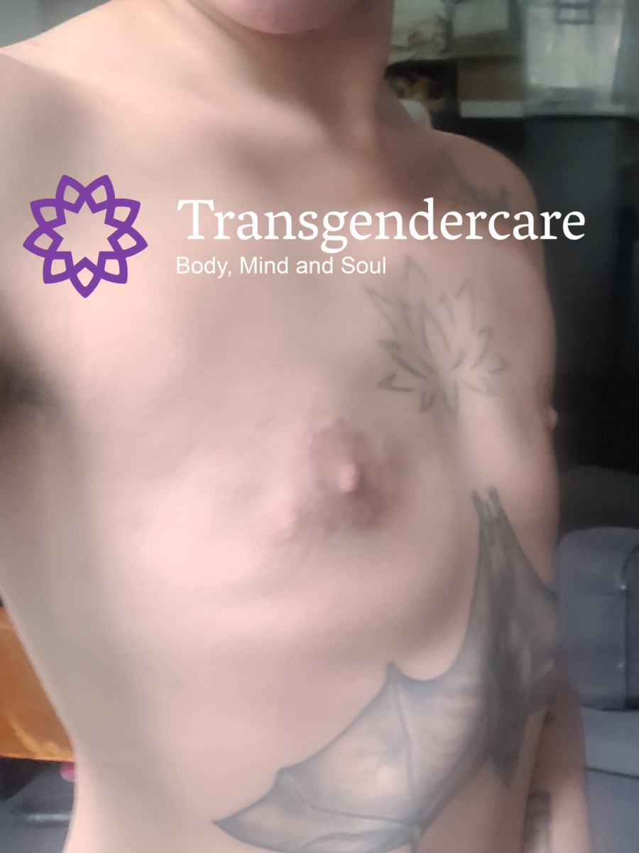 Peri Areolar Top Surgery 6 months with Mr Vahidi Transgendercare